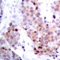 TP53 / p53 Antibody - Immunohistochemical analysis of p53 staining in human breast cancer formalin fixed paraffin embedded tissue section. The section was pre-treated using heat mediated antigen retrieval with sodium citrate buffer (pH 6.0). The section was then incubated with the antibody at room temperature and detected using an HRP polymer system. DAB was used as the chromogen. The section was then counterstained with hematoxylin and mounted with DPX.