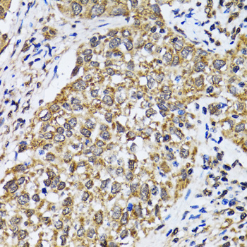 TP53 / p53 Antibody - Immunohistochemistry of paraffin-embedded human lung cancer tissue.