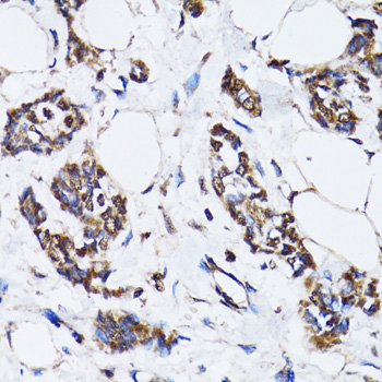 TP53 / p53 Antibody - Immunohistochemistry of paraffin-embedded human breast cancer tissue.
