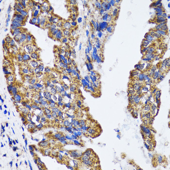 TP53 / p53 Antibody - Immunohistochemistry of paraffin-embedded human gastric cancer tissue.