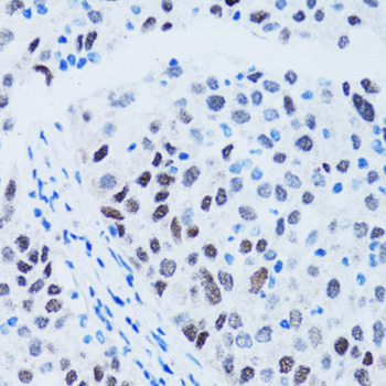 TP53 / p53 Antibody - Immunohistochemistry of paraffin-embedded human lung cancer using TP53 antibody at dilution of 1:100 (40x lens).