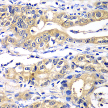 TP53 / p53 Antibody - Immunohistochemistry of paraffin-embedded human gastric cancer using TP53 antibody at dilution of 1:100 (40x lens).