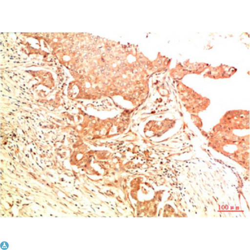 TP53 / p53 Antibody - Immunohistochemical analysis of paraffin-embedded Human Breast Carcinoma Tissue using Acetyl P53 (K382) Mouse mAb diluted at 1:200.