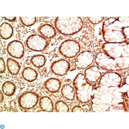 TP53 / p53 Antibody - Immunohistochemical analysis of paraffin-embedded Human Colon Carcinoma Tissue using Acetyl P53 (K382) Mouse mAb diluted at 1:200.