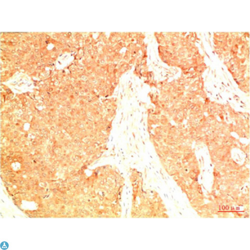 TP53 / p53 Antibody - Immunohistochemical analysis of paraffin-embedded Human Breast Carcinoma Tissue using Acetyl P53 (K382) Mouse mAb diluted at 1:200.