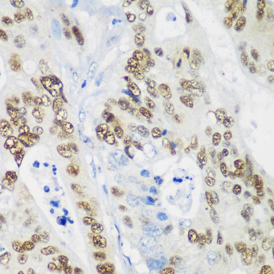 TP53 / p53 Antibody - Immunohistochemistry of paraffin-embedded Human colon carcinoma using p53 Polyclonal Antibody at dilution of 1:200 (40x lens).