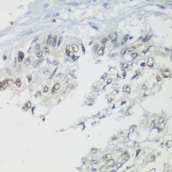 TP53 / p53 Antibody - Immunohistochemistry of paraffin-embedded Human lung cancer using p53 Polyclonal Antibody at dilution of 1:200 (40x lens).