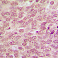 TP53 / p53 Antibody - Immunohistochemical analysis of p53 staining in human breast cancer formalin fixed paraffin embedded tissue section. The section was pre-treated using heat mediated antigen retrieval with sodium citrate buffer (pH 6.0). The section was then incubated with the antibody at room temperature and detected using an HRP conjugated compact polymer system. DAB was used as the chromogen. The section was then counterstained with hematoxylin and mounted with DPX.