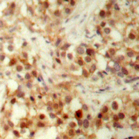 TP53 / p53 Antibody - Immunohistochemical analysis of p53 (pS6) staining in human ovarian cancer formalin fixed paraffin embedded tissue section. The section was pre-treated using heat mediated antigen retrieval with sodium citrate buffer (pH 6.0). The section was then incubated with the antibody at room temperature and detected using an HRP conjugated compact polymer system. DAB was used as the chromogen. The section was then counterstained with hematoxylin and mounted with DPX.