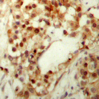 TP53 / p53 Antibody - Immunohistochemical analysis of p53 (pS9) staining in human ovarian cancer formalin fixed paraffin embedded tissue section. The section was pre-treated using heat mediated antigen retrieval with sodium citrate buffer (pH 6.0). The section was then incubated with the antibody at room temperature and detected using an HRP conjugated compact polymer system. DAB was used as the chromogen. The section was then counterstained with hematoxylin and mounted with DPX.