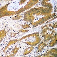 TP53 / p53 Antibody - Immunohistochemical analysis of p53 staining in human colon cancer formalin fixed paraffin embedded tissue section. The section was pre-treated using heat mediated antigen retrieval with sodium citrate buffer (pH 6.0). The section was then incubated with the antibody at room temperature and detected using an HRP polymer system. DAB was used as the chromogen. The section was then counterstained with hematoxylin and mounted with DPX.