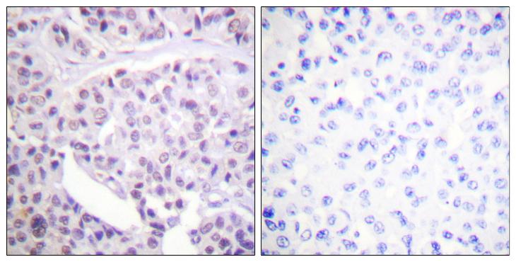 TP53 / p53 Antibody - Peptide - + Immunohistochemistry analysis of paraffin-embedded human breast carcinoma tissue using p53 (Ab-392) antibody.