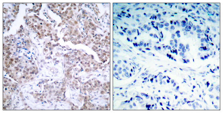 TP53 / p53 Antibody - Immunohistochemistry analysis of paraffin-embedded human breast carcinoma, using p53 (Phospho-Ser15) Antibody. The picture on the right is blocked with the phospho peptide.