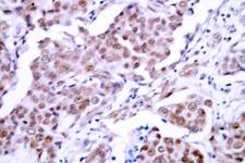 TP53 / p53 Antibody - IHC of p-p53 (S15) pAb in paraffin-embedded human breast carcinoma tissue.