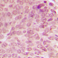TP53 / p53 Antibody - Immunohistochemical analysis of p53 (pS15) staining in human breast cancer formalin fixed paraffin embedded tissue section. The section was pre-treated using heat mediated antigen retrieval with sodium citrate buffer (pH 6.0). The section was then incubated with the antibody at room temperature and detected using an HRP conjugated compact polymer system. DAB was used as the chromogen. The section was then counterstained with hematoxylin and mounted with DPX.