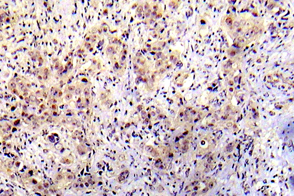 TP53 / p53 Antibody - IHC of p-P53 (S20) pAb in paraffin-embedded human breast carcinoma tissue.