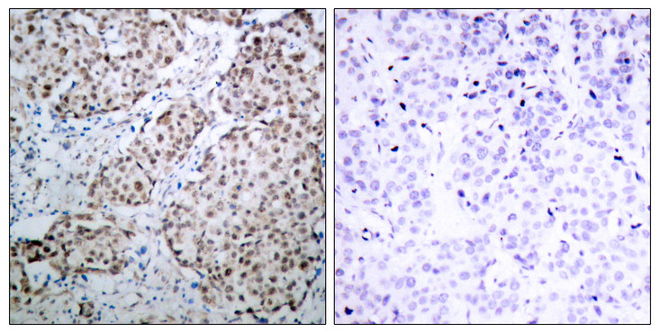 TP53 / p53 Antibody - Immunohistochemistry analysis of paraffin-embedded human breast carcinoma, using p53 (Phospho-Ser315) Antibody. The picture on the right is blocked with the phospho peptide.