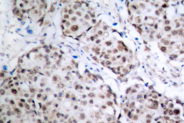 TP53 / p53 Antibody - IHC of p-p53 (S315) pAb in paraffin-embedded human breast carcinoma tissue.