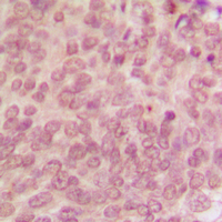 TP53 / p53 Antibody - Immunohistochemical analysis of p53 (pS315) staining in human breast cancer formalin fixed paraffin embedded tissue section. The section was pre-treated using heat mediated antigen retrieval with sodium citrate buffer (pH 6.0). The section was then incubated with the antibody at room temperature and detected using an HRP conjugated compact polymer system. DAB was used as the chromogen. The section was then counterstained with hematoxylin and mounted with DPX.