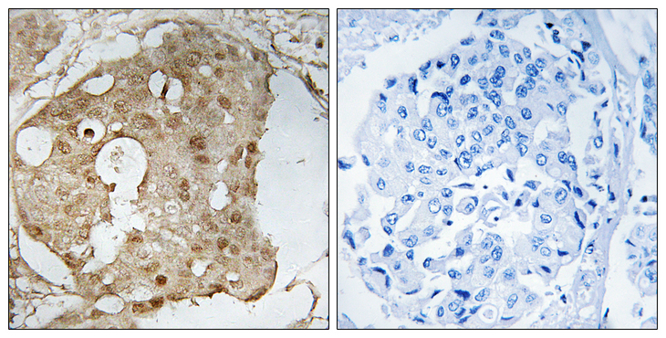TP53 / p53 Antibody - Immunohistochemistry analysis of paraffin-embedded human breast carcinoma, using p53 (Phospho-Ser366) Antibody. The picture on the right is blocked with the phospho peptide.