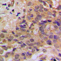TP53 / p53 Antibody - Immunohistochemical analysis of p53 (pS37) staining in human breast cancer formalin fixed paraffin embedded tissue section. The section was pre-treated using heat mediated antigen retrieval with sodium citrate buffer (pH 6.0). The section was then incubated with the antibody at room temperature and detected using an HRP conjugated compact polymer system. DAB was used as the chromogen. The section was then counterstained with hematoxylin and mounted with DPX.