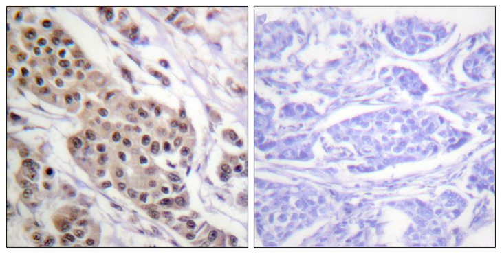 TP53 / p53 Antibody - Immunohistochemistry analysis of paraffin-embedded human breast carcinoma, using p53 (Phospho-Ser392) Antibody. The picture on the right is blocked with the phospho peptide.