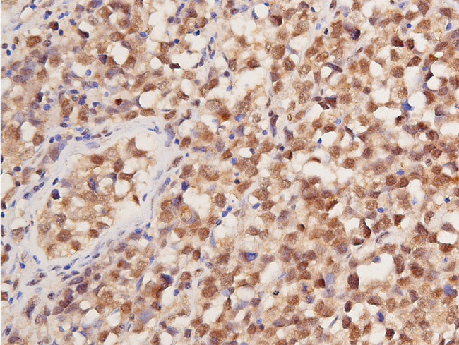 TP53 / p53 Antibody - 1:100 staining human seminoma tissue by IHC-P. The tissue was formaldehyde fixed and a heat mediated antigen retrieval step in citrate buffer was performed. The tissue was then blocked and incubated with the antibody for 1.5 hours at 22°C. An HRP conjugated goat anti-rabbit antibody was used as the secondary.