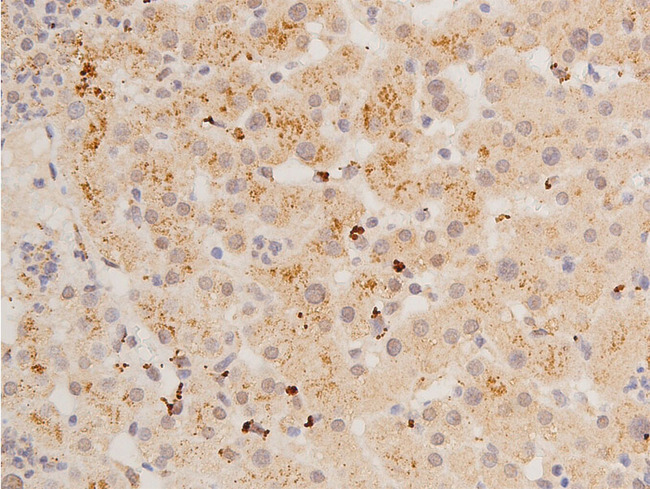 TP53 / p53 Antibody - 1:100 staining human liver tissue by IHC-P. The tissue was formaldehyde fixed and a heat mediated antigen retrieval step in citrate buffer was performed. The tissue was then blocked and incubated with the antibody for 1.5 hours at 22°C. An HRP conjugated goat anti-rabbit antibody was used as the secondary.