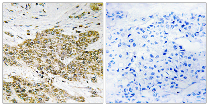 TP53 / p53 Antibody - Immunohistochemistry analysis of paraffin-embedded human breast carcinoma, using p53 (Phospho-Ser6) Antibody. The picture on the right is blocked with the phospho peptide.