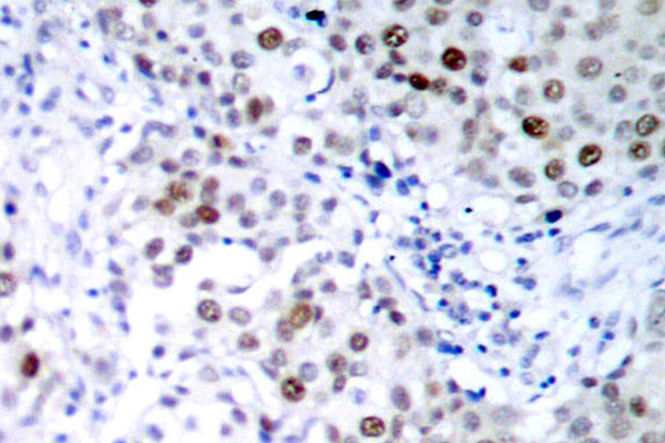 TP53 / p53 Antibody - IHC of p-p53 (S6) pAb in paraffin-embedded human breast carcinoma tissue.