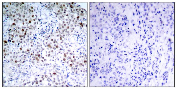 TP53 / p53 Antibody - P-Peptide - + Immunohistochemical analysis of paraffin-embedded human breast carcinoma tissue using p53 (phospho- Ser6) antibody.