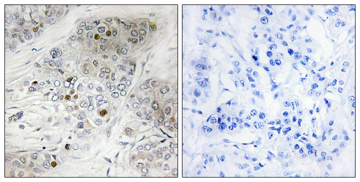 TP53 / p53 Antibody - Immunohistochemistry analysis of paraffin-embedded human breast carcinoma, using p53 (Phospho-Ser9) Antibody. The picture on the right is blocked with the phospho peptide.