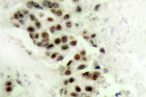 TP53 / p53 Antibody - Immunohistochemistry(IHC) analysis of p-p53 (S9) pAb in paraffin-embedded human breast carcinoma tissue.