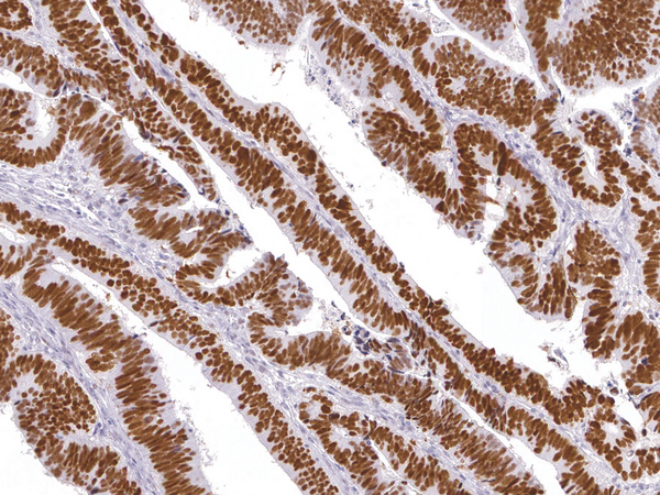 TP53 / p53 Antibody - Human Colon Cancer