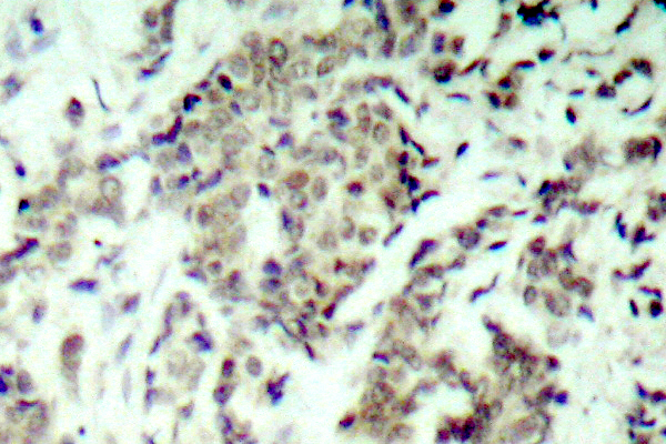 TP53 / p53 Antibody - IHC of p53 (S9) pAb in paraffin-embedded human breast carcinoma tissue.