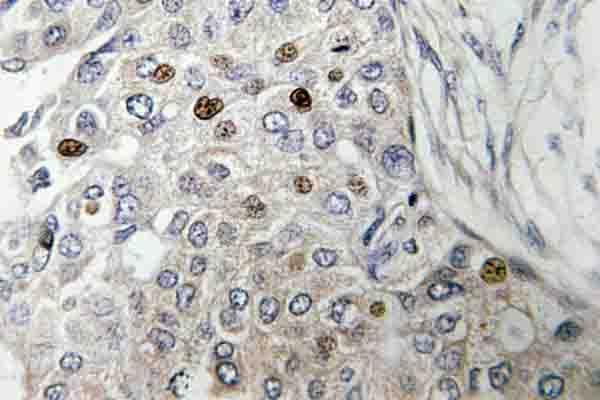 TP53 / p53 Antibody - IHC of p53 (V31) pAb in paraffin-embedded human breast carcinoma tissue.