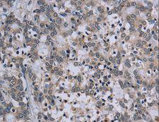 TP53AIP1 / p53 AIP1 Antibody - Immunohistochemistry of paraffin-embedded Human lung cancer using TP53AIP1 Polyclonal Antibody at dilution of 1:50.