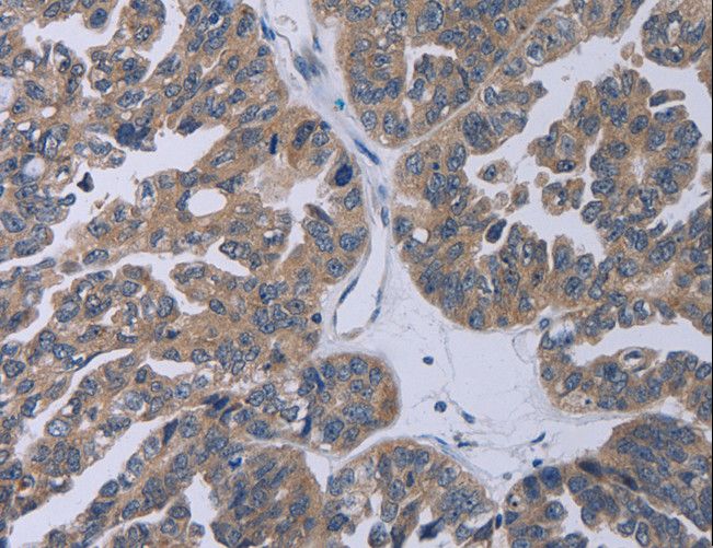 TP53AIP1 / p53 AIP1 Antibody - Immunohistochemistry of paraffin-embedded Human cervical cancer using TP53AIP1 Polyclonal Antibody at dilution of 1:50.