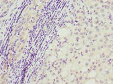 TP53AIP1 / p53 AIP1 Antibody - Immunohistochemistry of paraffin-embedded human liver cancer at dilution 1:100