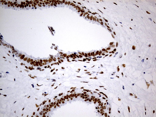 TP53BP1 / 53BP1 Antibody - Immunohistochemical staining of paraffin-embedded Human breast tissue within the normal limits using anti-TP53BP1 mouse monoclonal antibody. (Heat-induced epitope retrieval by 1mM EDTA in 10mM Tris buffer. (pH8.5) at 120°C for 3 min. (1:500)
