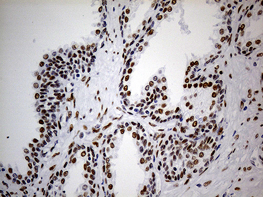 TP53BP1 / 53BP1 Antibody - Immunohistochemical staining of paraffin-embedded Human prostate tissue within the normal limits using anti-TP53BP1 mouse monoclonal antibody. (Heat-induced epitope retrieval by 1mM EDTA in 10mM Tris buffer. (pH8.5) at 120°C for 3 min. (1:500)