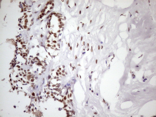 TP53BP1 / 53BP1 Antibody - Immunohistochemical staining of paraffin-embedded Human breast tissue within the normal limits using anti-TP53BP1 mouse monoclonal antibody. (Heat-induced epitope retrieval by 1 mM EDTA in 10mM Tris, pH8.5, 120C for 3min. (1:150)