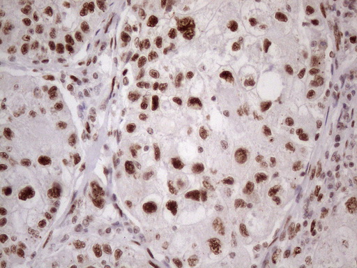TP53BP1 / 53BP1 Antibody - Immunohistochemical staining of paraffin-embedded Carcinoma of Human lung tissue using anti-TP53BP1 mouse monoclonal antibody. (Heat-induced epitope retrieval by 1 mM EDTA in 10mM Tris, pH8.5, 120C for 3min. (1:150)