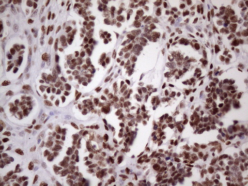 TP53BP1 / 53BP1 Antibody - Immunohistochemical staining of paraffin-embedded Adenocarcinoma of Human ovary tissue using anti-TP53BP1 mouse monoclonal antibody. (Heat-induced epitope retrieval by 1 mM EDTA in 10mM Tris, pH8.5, 120C for 3min. (1:150)