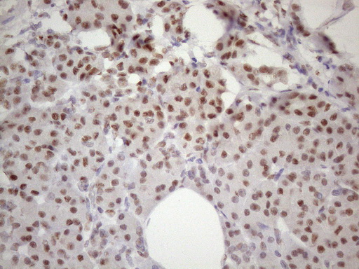 TP53BP1 / 53BP1 Antibody - Immunohistochemical staining of paraffin-embedded Human pancreas tissue within the normal limits using anti-TP53BP1 mouse monoclonal antibody. (Heat-induced epitope retrieval by 1 mM EDTA in 10mM Tris, pH8.5, 120C for 3min. (1:150)