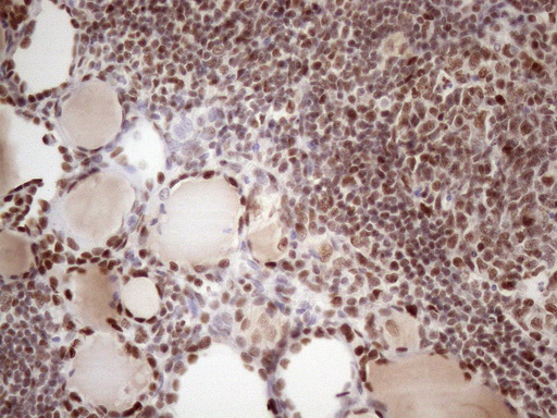 TP53BP1 / 53BP1 Antibody - Immunohistochemical staining of paraffin-embedded Human thyroid tissue within the normal limits using anti-TP53BP1 mouse monoclonal antibody. (Heat-induced epitope retrieval by 1 mM EDTA in 10mM Tris, pH8.5, 120C for 3min. (1:150)