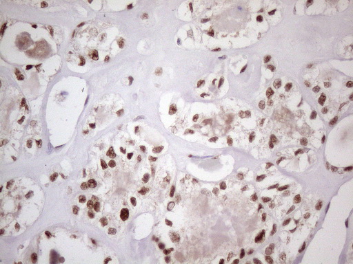 TP53BP1 / 53BP1 Antibody - Immunohistochemical staining of paraffin-embedded Carcinoma of Human thyroid tissue using anti-TP53BP1 mouse monoclonal antibody. (Heat-induced epitope retrieval by 1 mM EDTA in 10mM Tris, pH8.5, 120C for 3min. (1:150)