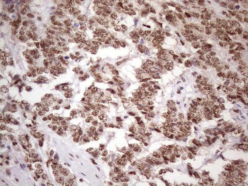 TP53BP1 / 53BP1 Antibody - Immunohistochemical staining of paraffin-embedded Adenocarcinoma of Human endometrium tissue using anti-TP53BP1 mouse monoclonal antibody. (Heat-induced epitope retrieval by 1 mM EDTA in 10mM Tris, pH8.5, 120C for 3min. (1:150)