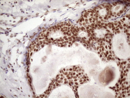 TP53BP1 / 53BP1 Antibody - Immunohistochemical staining of paraffin-embedded Adenocarcinoma of Human breast tissue using anti-TP53BP1 mouse monoclonal antibody. (Heat-induced epitope retrieval by 1 mM EDTA in 10mM Tris, pH8.5, 120C for 3min. (1:150)