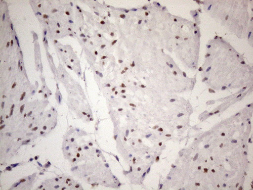 TP53BP1 / 53BP1 Antibody - Immunohistochemical staining of paraffin-embedded Carcinoma of Human bladder tissue using anti-TP53BP1 mouse monoclonal antibody. (Heat-induced epitope retrieval by 1 mM EDTA in 10mM Tris, pH8.5, 120C for 3min. (1:150)